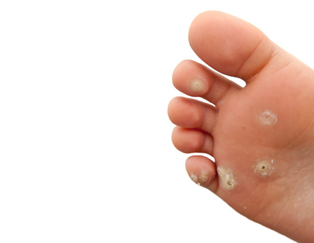 warts, plantar on foot_sum.jpg